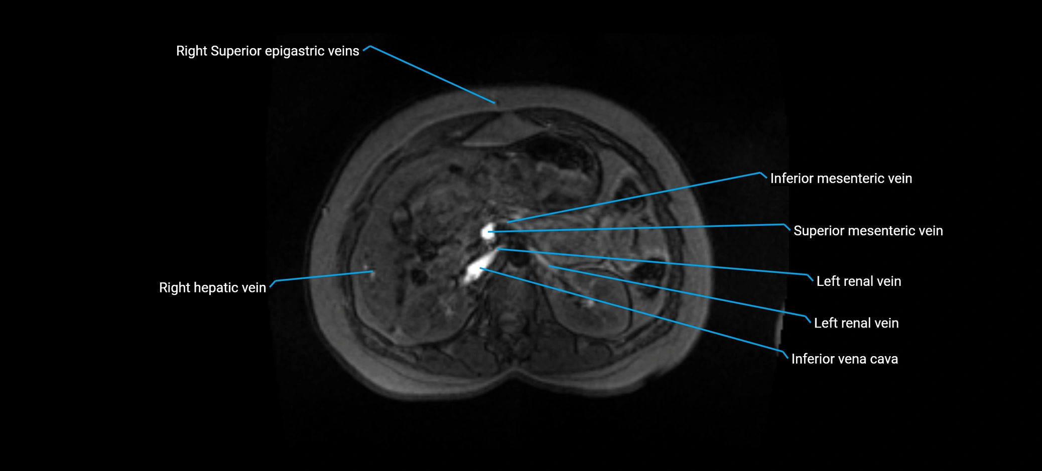 MRV abdomen pelvis & lower limb axial cross sectional anatomy labelled MRI image 59 (1).webp